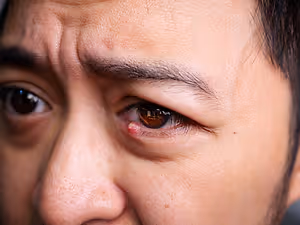 A closeup view of a person's face with a red spot on the eye