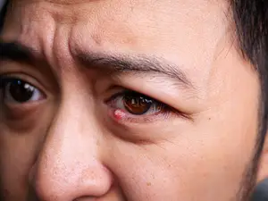 A closeup view of a person's face with a red spot on the eye