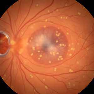 Fundus image showing retinal veins with scattered yellowish deposits and a central area with mild discoloration.