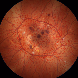 Fluorescein angiogram of the retina with numerous dots and vascular abnormalities.