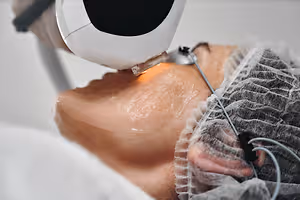 Close up of a woman getting a laser treatment on her neck