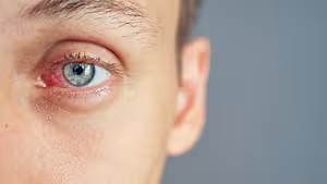 Close-up of a man's eye with a red spot on the white part, likely a blood vessel.