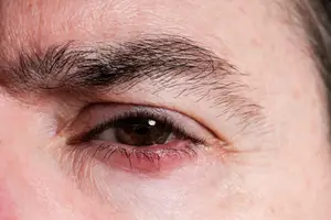 Close up of a man's eye with a swollen eyelid and red eye