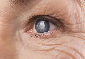 Close up of elderly person's eye with cataracts