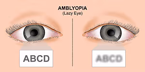 An illustration showing the comparison between normal vision and amblyopia in the eyes with labels ABCDE