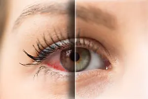 Before and after image of a woman's eye with red veins and swollen skin before treatment and clear skin and eye after treatment