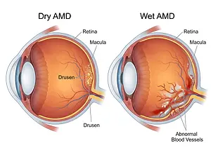 Illustration comparing dry and wet age-related macular degeneration, showing drusen in dry AMD and abnormal blood vessels in wet AMD