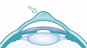 Cross-sectional illustration of the eye showing a cataract as a cloudy lens, with a downward arrow pointing to the clouded area.