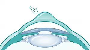 Cross-sectional illustration of the eye showing a cataract as a cloudy lens, with a downward arrow pointing to the clouded area.