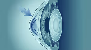 Illustration of an eye with an arrow pointing to the cornea