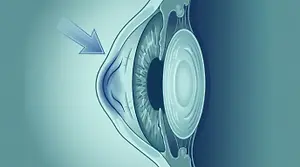 Illustration of an eye with an arrow pointing to the cornea