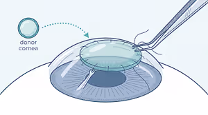 Diagram showing a donor cornea being placed on the eye during corneal transplant surgery.