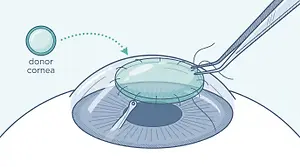 Diagram showing a donor cornea being placed on the eye during corneal transplant surgery.
