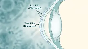 Illustration of the eye with a disrupted tear film shown twice