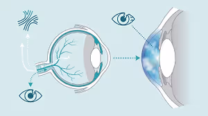 Illustration of the human eye showing the flow of aqueous humor from the anterior chamber to the Schlemm's canal