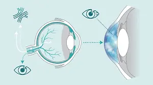 Illustration of the human eye showing the flow of aqueous humor from the anterior chamber to the Schlemm's canal