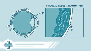 Illustration showing a cross section of the eye with mucosal tissue inflammation highlighted.