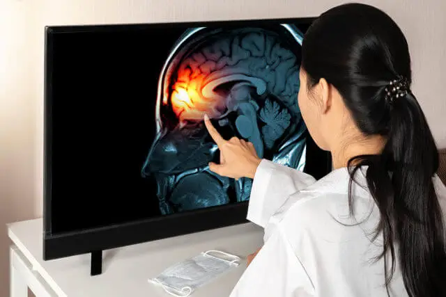 Doctor pointing to a brain scan on a monitor