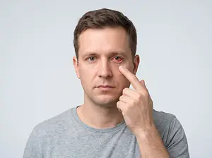 Man pointing to a red, irritated eye