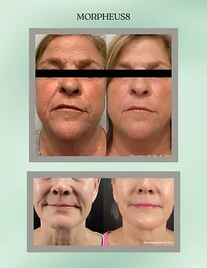 Before-and-after facial photos showing reduced wrinkles and smoother skin following Morpheus8 treatment.