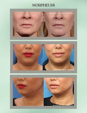 Morpheus8 before-and-after photos showing improved facial skin texture and contour from front and side views