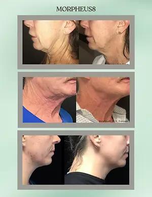 Morpheus8 before-and-after photos showing improved jawline and neck skin appearance in three patients