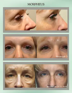 Morpheus8 before-and-after facial treatment photos showing changes around the eyes and forehead