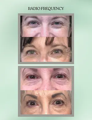 Radiofrequency treatment before-and-after photos showing changes around the eyes