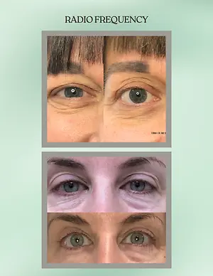 Radiofrequency eye treatment before-and-after photos showing reduced under-eye wrinkles and smoother eyelid skin
