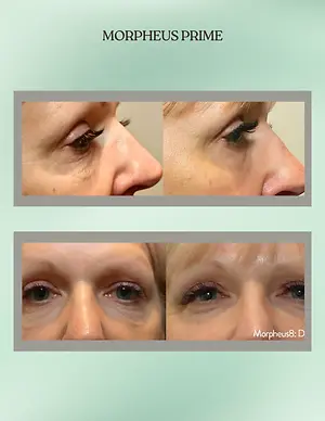 Morpheus8 before-and-after photos showing reduced under-eye wrinkles and lifted eyelids