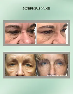 Morpheus Prime before-and-after photos showing reduced under-eye bags and smoother skin around the eyes