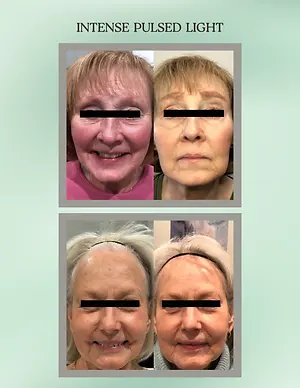 Before-and-after facial photos showing changes around the eyes following intense pulsed light treatment