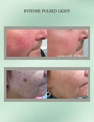 Before-and-after photos showing reduced facial redness, visible veins, and sun spots following intense pulsed light treatment.