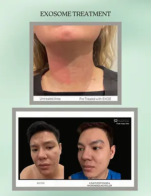 Exosome treatment before-and-after images showing reduced skin redness and acne appearance