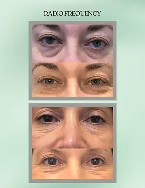 Before-and-after photos showing reduced under-eye bags and wrinkles following radiofrequency treatment