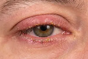 A close-up view of a human eye with blepharitis, showing inflammation and crusting around the eyelids.