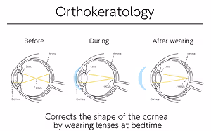 A diagram shows the process of Orthokeratology, correcting the cornea's shape by wearing lenses at bedtime.
