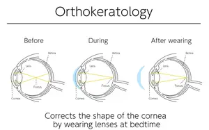 A diagram shows the process of Orthokeratology, correcting the cornea's shape by wearing lenses at bedtime.