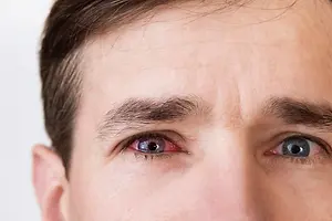 A close-up of a man's face with one eye having red spots on the sclera, while the other eye appears normal, he has slightly furrowed eyebrows and is looking straight ahead