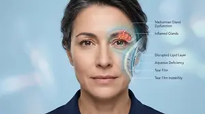 Illustration of a woman's face highlighting various eye and tear-related issues including Meibomian Gland Dysfunction, inflamed glands, disrupted lipid layer, aqueous deficiency, tear film, and tear film instability.