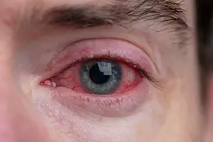 Close-up of a red, irritated eye with blurred background