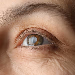 glaucoma close up