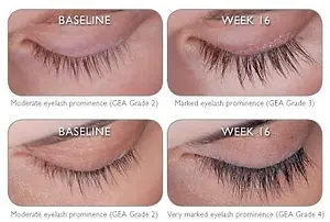A comparison of eye lash prominence before and after treatment, with a label indicating the improvement in lash prominence from baseline to week 16.