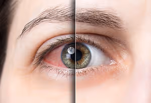 A close-up of a woman's eye with a red, irritated eye and a healthy eye next to it.