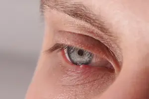 A close-up of a person's eye with a red spot on the eyelid.