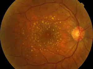 fundus image showing retinal pigment epithelial atrophy