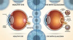 Medical illustration comparing a healthy eye with an eye affected by glaucoma, showing optic nerve damage and retinal changes