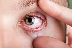 A closeup of a man's eye with a red eye and blurry vision