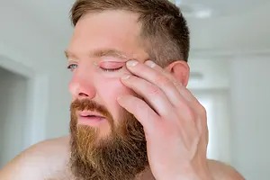 A bearded man is rubbing his eyes, possibly feeling tired or having an eye infection, with his left hand while looking down, his eyes slightly closed, and his right hand resting on his face.