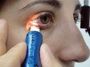 A close-up of a person using a blue medical device to treat their eye, possibly for dry eye syndrome.